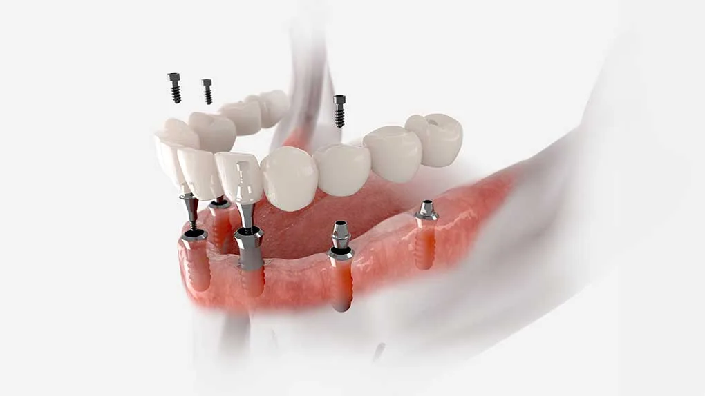 All-on-6 Dental Implants